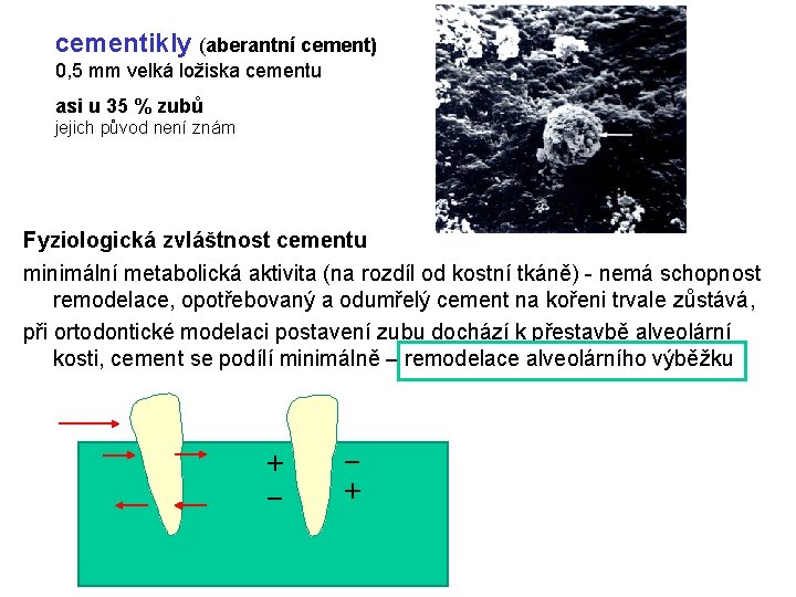 cementikly (aberantní cement) 0, 5 mm velká ložiska cementu asi u 35 % zubů
