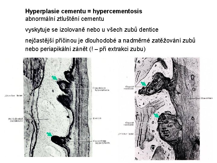 Hyperplasie cementu = hypercementosis abnormální ztluštění cementu vyskytuje se izolovaně nebo u všech zubů