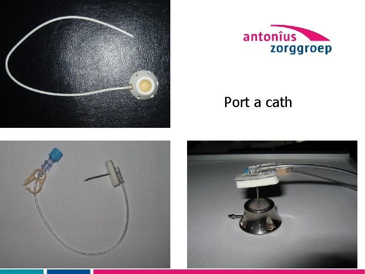 Port a cath 