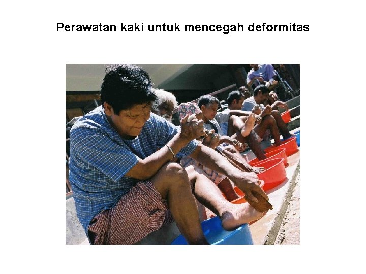 Perawatan kaki untuk mencegah deformitas 