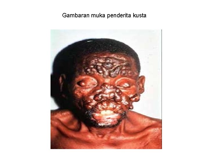 Gambaran muka penderita kusta 