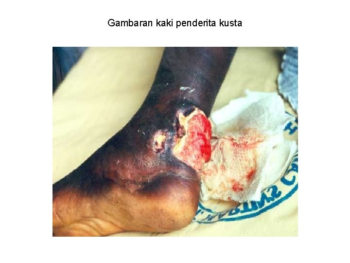Gambaran kaki penderita kusta 