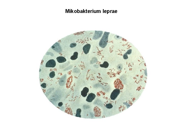 Mikobakterium leprae 