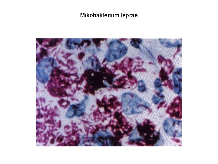 Mikobakterium leprae 