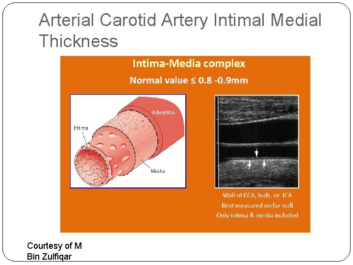 Arterial Carotid Artery Intimal Medial Thickness Courtesy of M Bin Zulfiqar 
