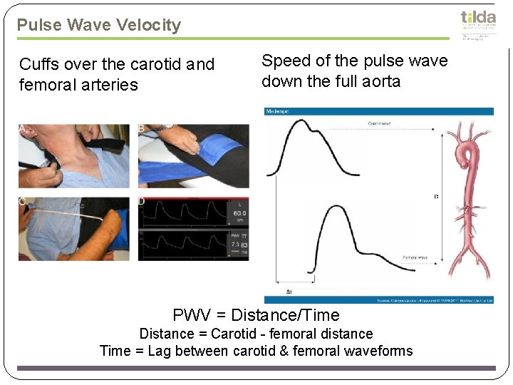 Pulse Wave Velocity Cuffs over the carotid and femoral arteries Speed of the pulse