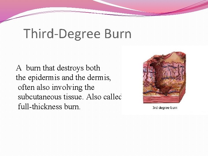 Third-Degree Burn A burn that destroys both the epidermis and the dermis, often also