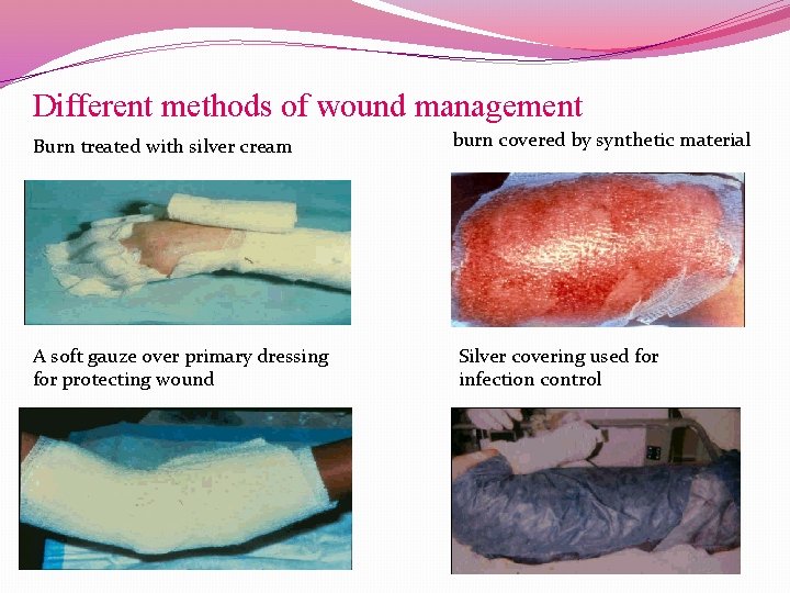 Different methods of wound management Burn treated with silver cream A soft gauze over
