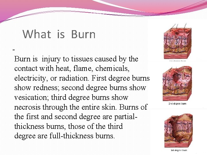 What is Burn - Burn is injury to tissues caused by the contact with