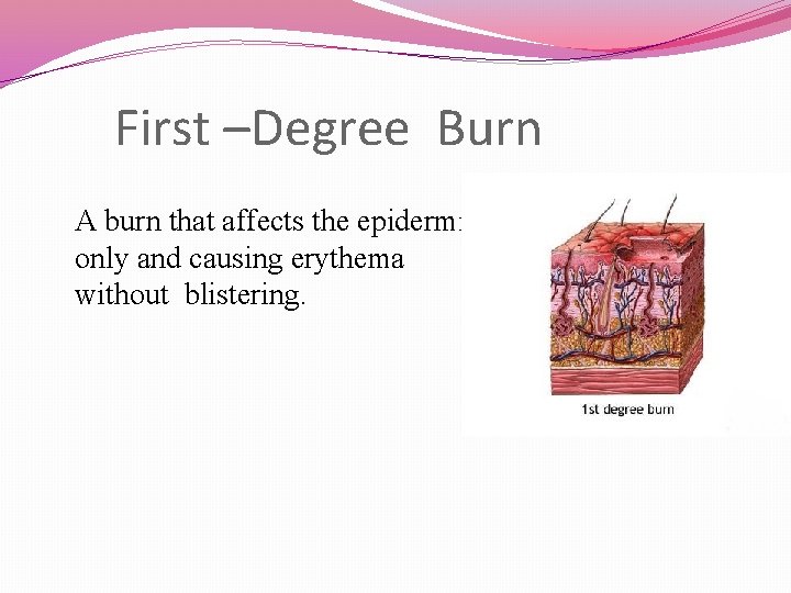 First –Degree Burn A burn that affects the epidermis only and causing erythema without