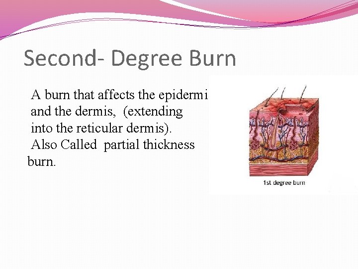 Second- Degree Burn A burn that affects the epidermis and the dermis, (extending into