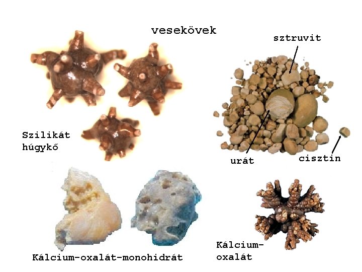 vesekövek sztruvit Szilikát húgykő urát Kálcium-oxalát-monohidrát Kálciumoxalát cisztin 