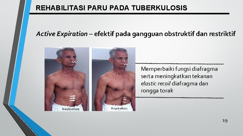 REHABILITASI PARU PADA TUBERKULOSIS Active Expiration – efektif pada gangguan obstruktif dan restriktif Memperbaiki