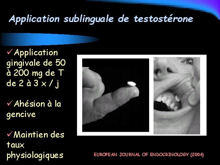 Application sublinguale de testostérone üApplication gingivale de 50 à 200 mg de T de
