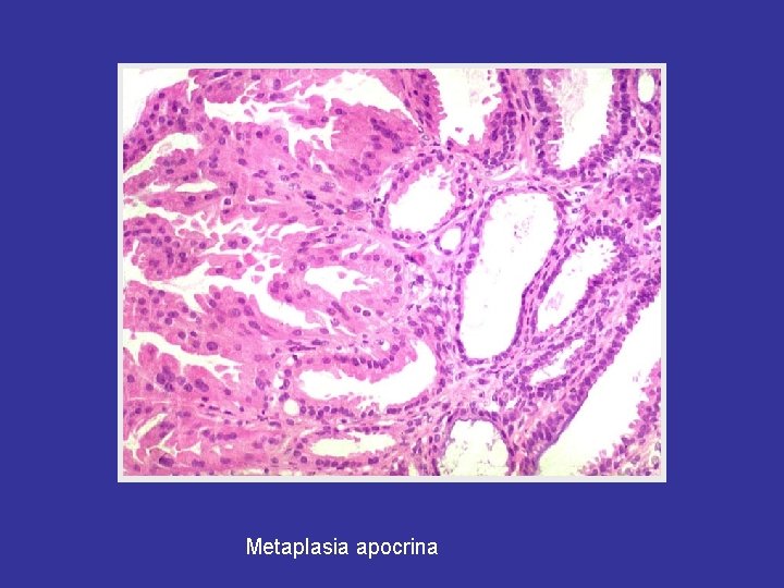 Metaplasia apocrina 