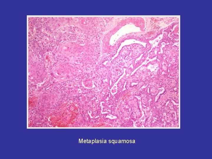 Metaplasia squamosa 