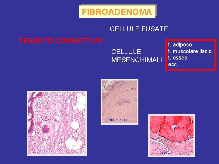 FIBROADENOMA CELLULE FUSATE TESSUTO CONNETTIVO CELLULE MESENCHIMALI t. adiposo t. muscolare liscio t. osseo