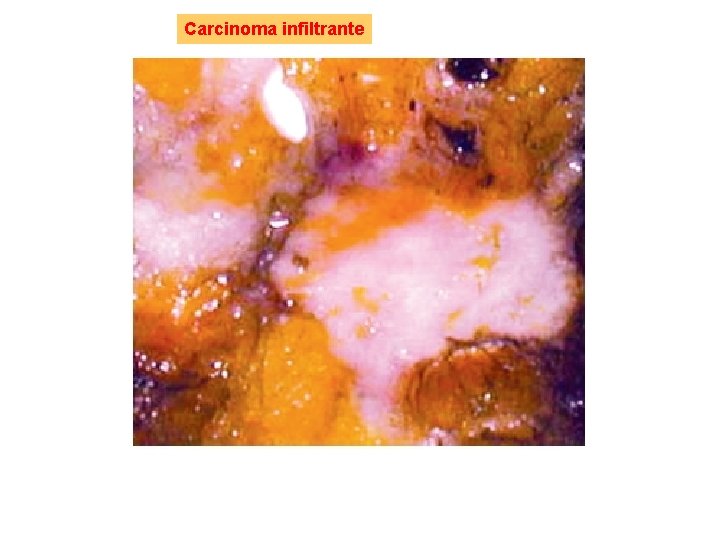 Carcinoma infiltrante 