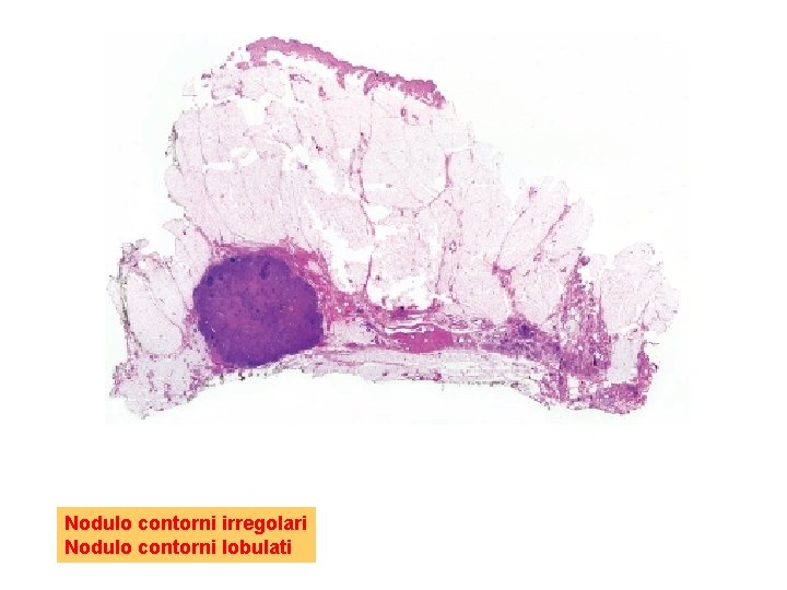 Nodulo contorni irregolari Nodulo contorni lobulati 