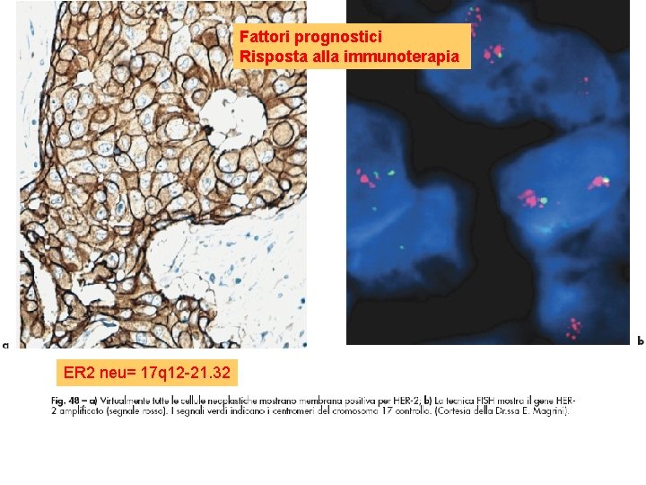 Fattori prognostici Risposta alla immunoterapia ER 2 neu= 17 q 12 -21. 32 