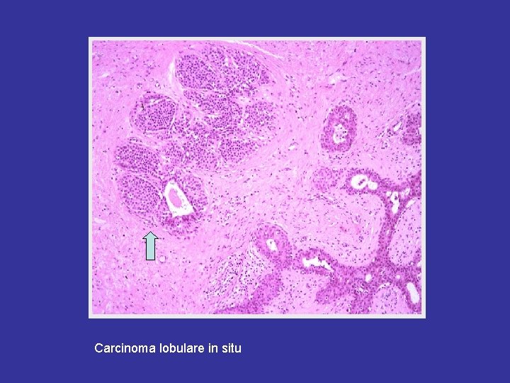 Carcinoma lobulare in situ 