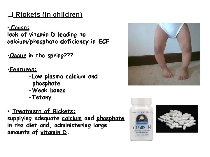  Rickets (In children) • Cause: lack of vitamin D leading to calcium/phosphate deficiency