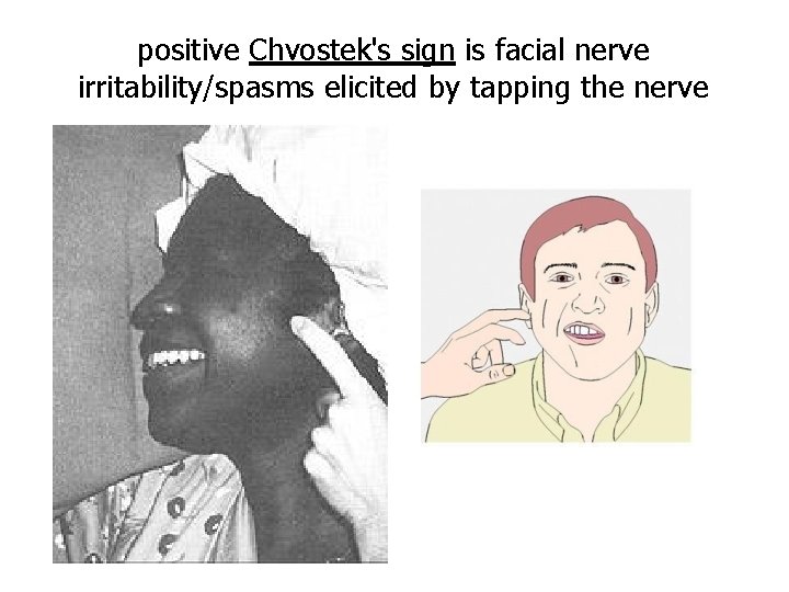 positive Chvostek's sign is facial nerve irritability/spasms elicited by tapping the nerve 