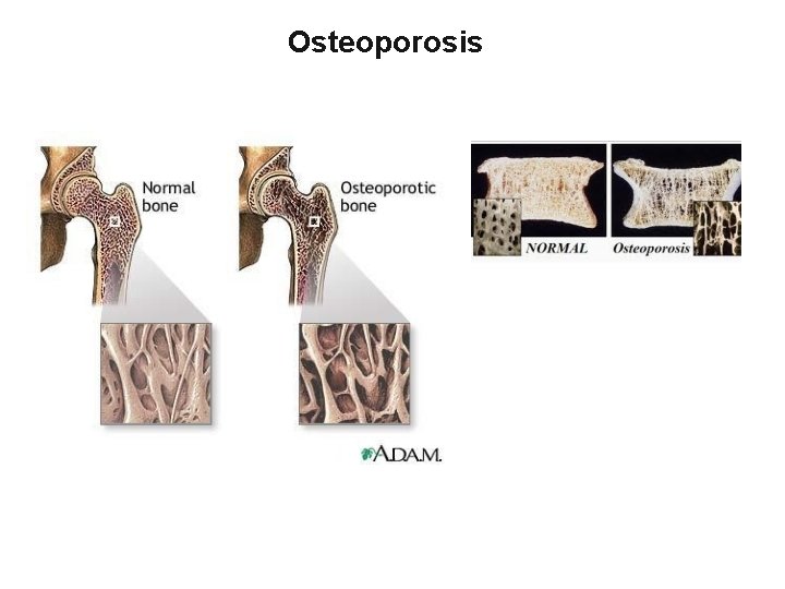 Osteoporosis 