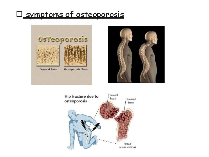  symptoms of osteoporosis 