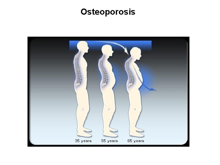 Osteoporosis 