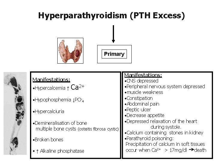 Hyperparathyroidism (PTH Excess) Primary Manifestations: • Hypercalcemia ↑ Ca 2+ • Hypophosphemia ↓PO-4 •