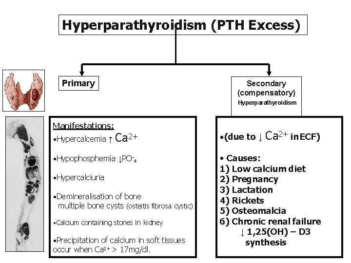 Hyperparathyroidism (PTH Excess) Primary Secondary (compensatory) Hyperparathyroidism Manifestations: • Hypercalcemia ↑ Ca 2+ •