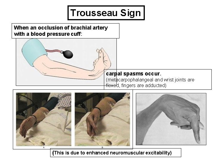 Trousseau Sign When an occlusion of brachial artery with a blood pressure cuff: carpal