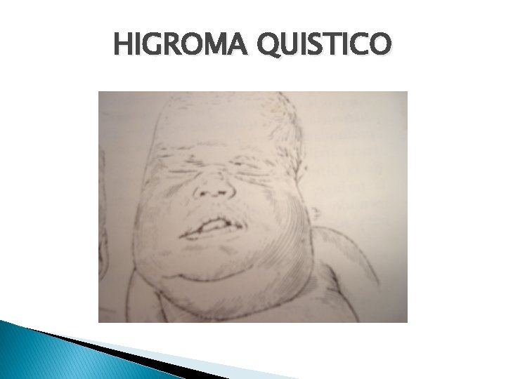 HIGROMA QUISTICO 