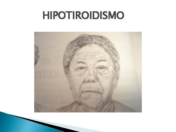 HIPOTIROIDISMO 