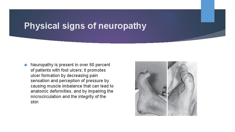 Physical signs of neuropathy Neuropathy is present in over 80 percent of patients with