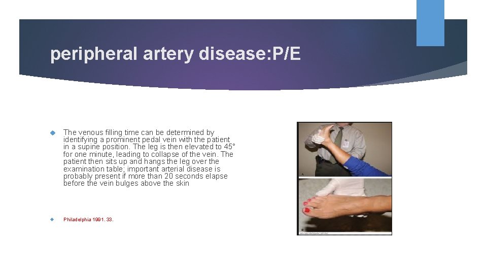peripheral artery disease: P/E The venous filling time can be determined by identifying a