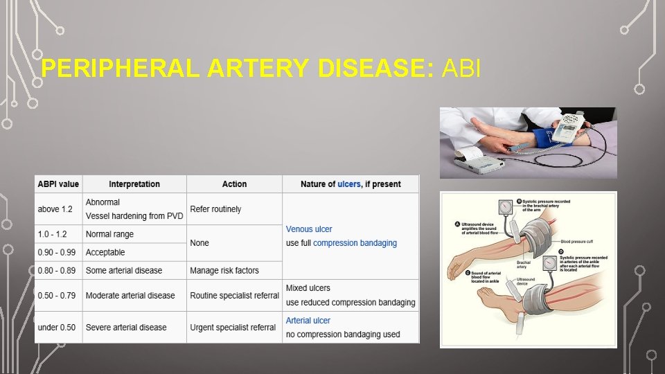 PERIPHERAL ARTERY DISEASE: ABI 