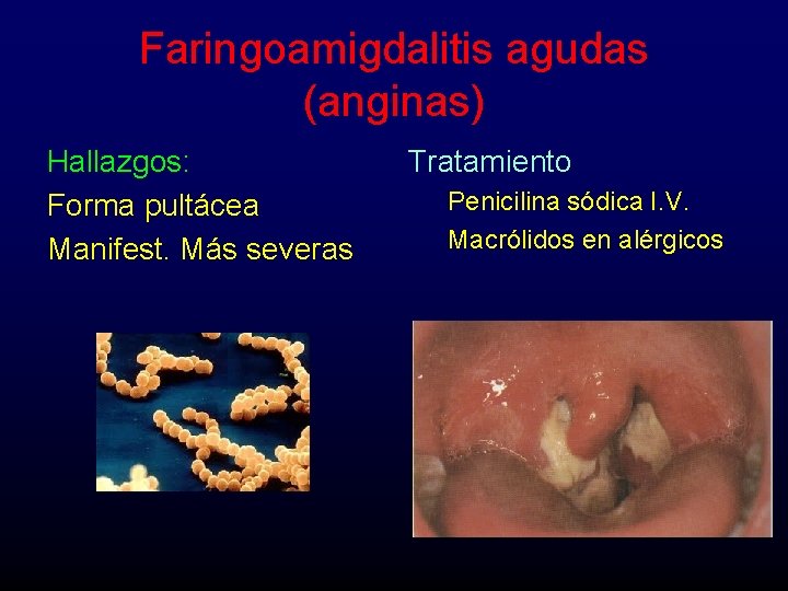 Faringoamigdalitis agudas (anginas) Hallazgos: Forma pultácea Manifest. Más severas Tratamiento Penicilina sódica I. V.