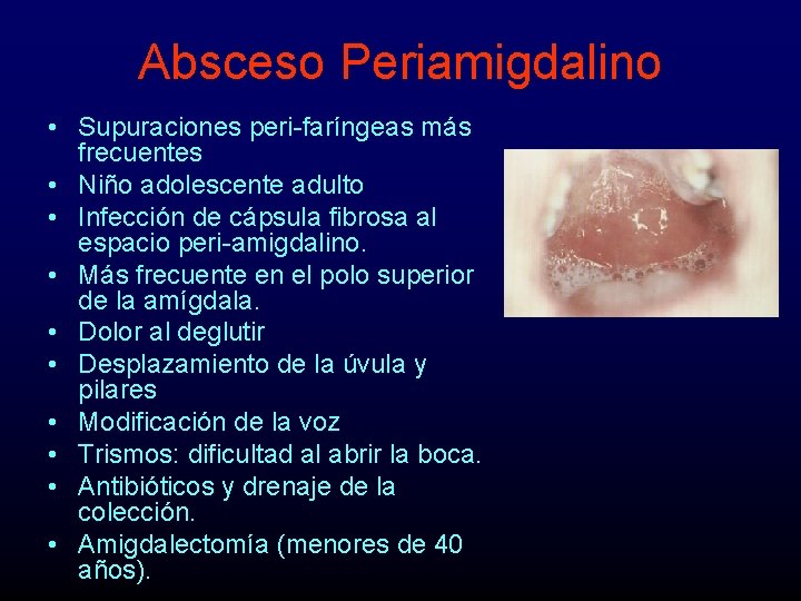 Absceso Periamigdalino • Supuraciones peri-faríngeas más frecuentes • Niño adolescente adulto • Infección de