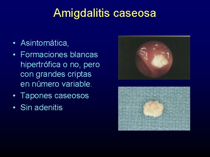 Amigdalitis caseosa • Asintomática, • Formaciones blancas hipertrófica o no, pero con grandes criptas