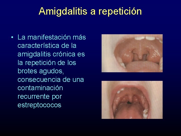 Amigdalitis a repetición • La manifestación más característica de la amigdalitis crónica es la