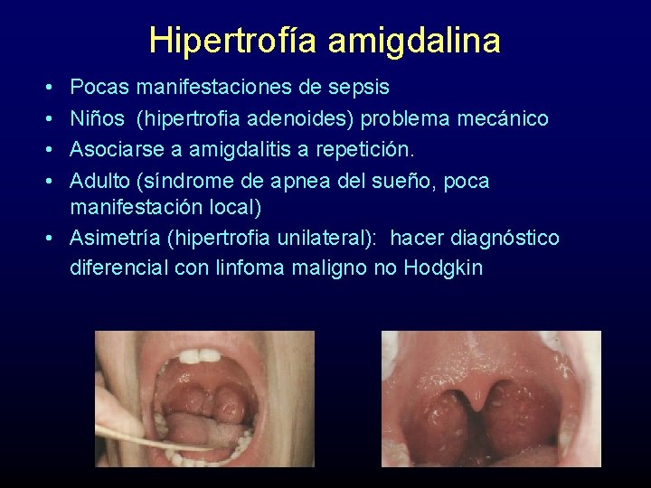 Hipertrofía amigdalina • • Pocas manifestaciones de sepsis Niños (hipertrofia adenoides) problema mecánico Asociarse