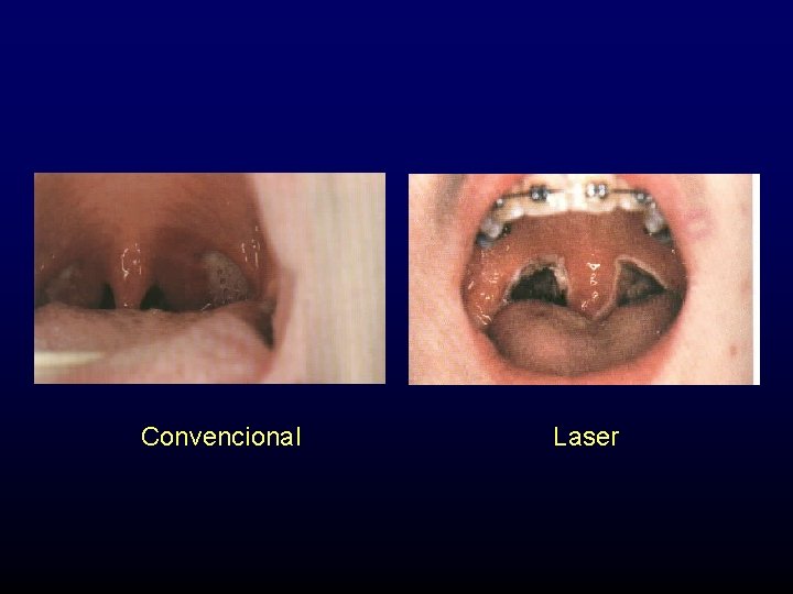 Convencional Laser 