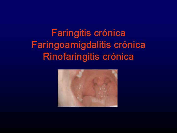 Faringitis crónica Faringoamigdalitis crónica Rinofaringitis crónica 