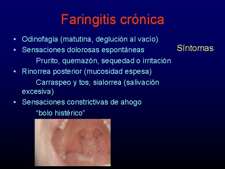 Faringitis crónica • Odinofagia (matutina, deglución al vacío) Síntomas • Sensaciones dolorosas espontáneas Prurito,