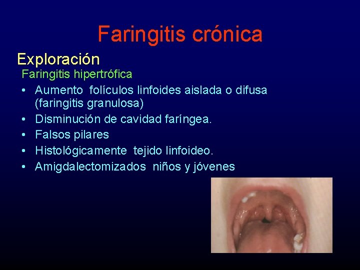 Faringitis crónica Exploración Faringitis hipertrófica • Aumento folículos linfoides aislada o difusa (faringitis granulosa)