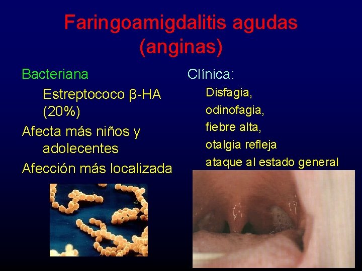 Faringoamigdalitis agudas (anginas) Bacteriana Estreptococo β-HA (20%) Afecta más niños y adolecentes Afección más