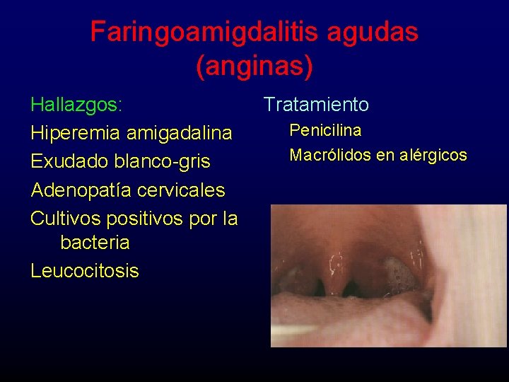 Faringoamigdalitis agudas (anginas) Hallazgos: Hiperemia amigadalina Exudado blanco-gris Adenopatía cervicales Cultivos positivos por la