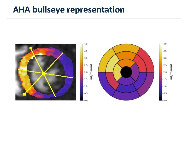 AHA bullseye representation 